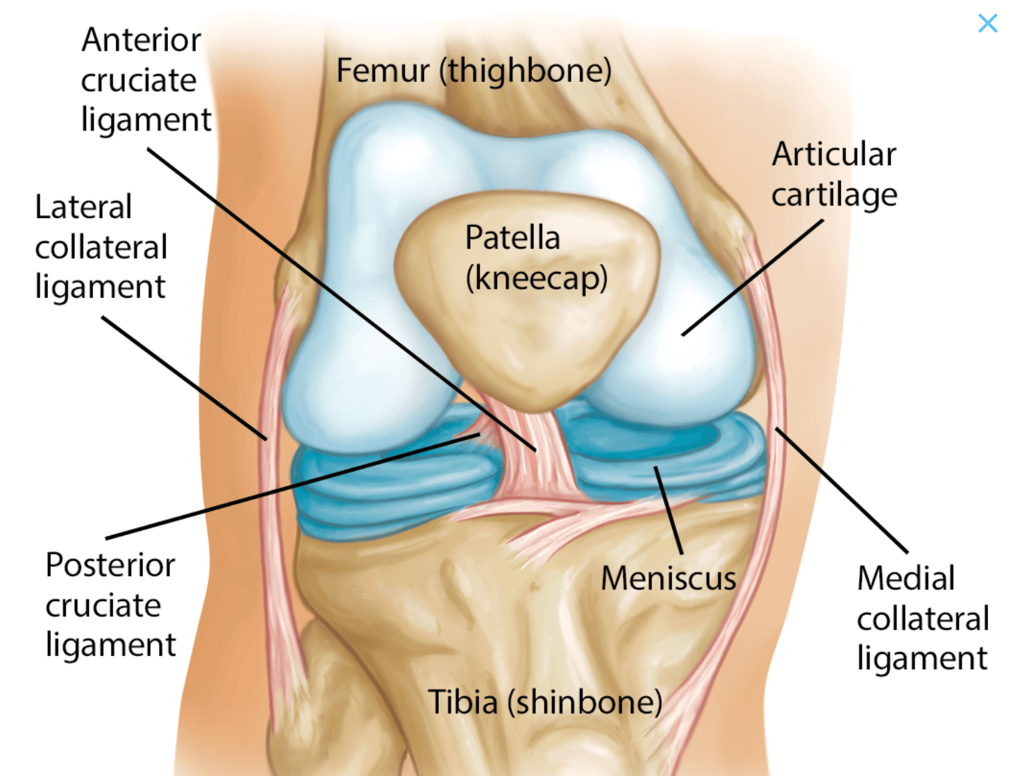 Labeled illustration of knee anatomy and arthritis