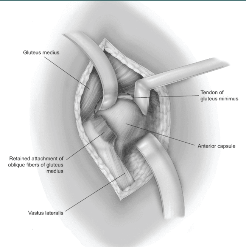 Demonstration of the Mayo modified anterolateral interval and surrounding anatomy